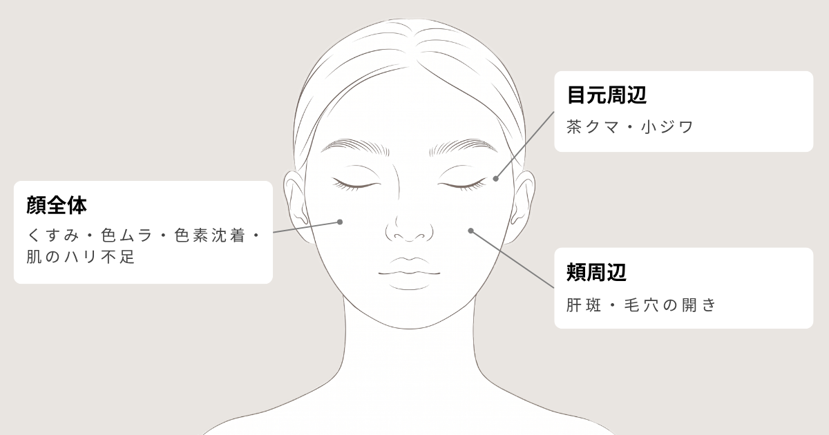 ピンクグローの適応部位図。顔全体（くすみ・色ムラ・色素沈着・肌のハリ不足）、目元周辺（茶クマ・小ジワ）、頬周辺（肝斑・毛穴の開き）